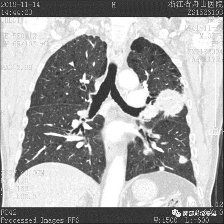 【病例】真假支气管爬行征—肺腺癌1例CT影像讨论 【病例】真假支气管爬行征—肺腺癌1例CT影像讨论