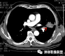 【病例】真假支气管爬行征—肺腺癌1例CT影像讨论 【病例】真假支气管爬行征—肺腺癌1例CT影像讨论