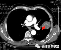 【病例】真假支气管爬行征—肺腺癌1例CT影像讨论 【病例】真假支气管爬行征—肺腺癌1例CT影像讨论