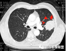【病例】真假支气管爬行征—肺腺癌1例CT影像讨论 【病例】真假支气管爬行征—肺腺癌1例CT影像讨论
