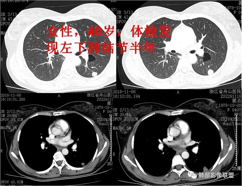 【病例】肺结节2例影像讨论 【病例】肺结节2例影像讨论