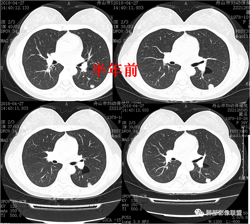 【病例】肺结节2例影像讨论 【病例】肺结节2例影像讨论