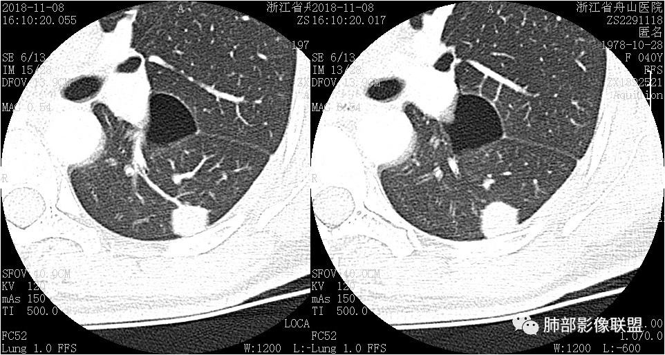 【病例】肺结节2例影像讨论 【病例】肺结节2例影像讨论