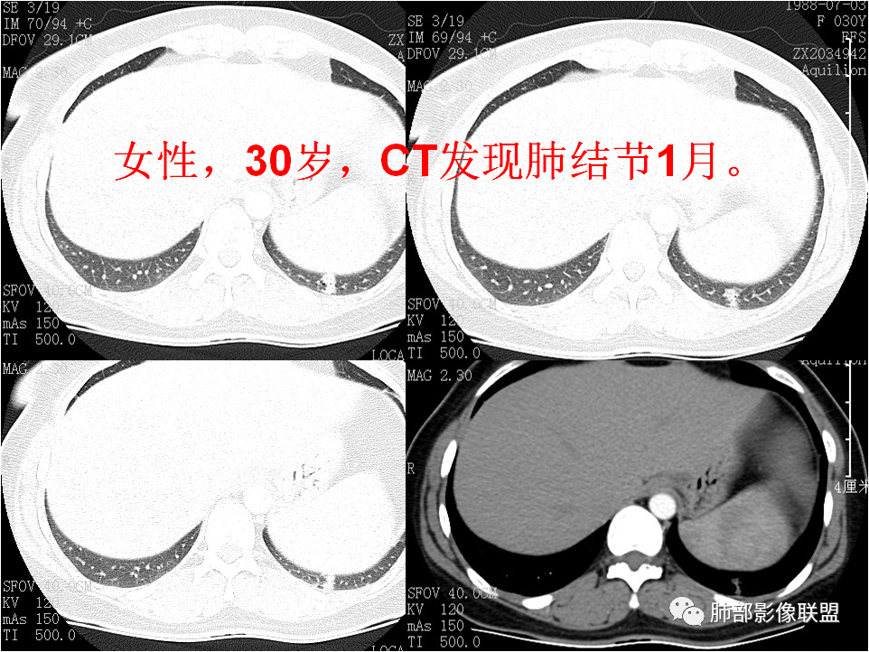 【病例】肺结节2例影像讨论 【病例】肺结节2例影像讨论