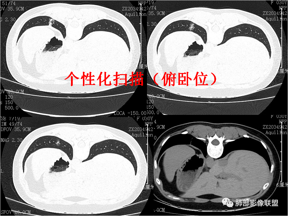 【病例】肺结节2例影像讨论 【病例】肺结节2例影像讨论