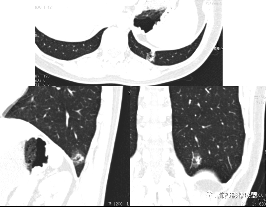 【病例】肺结节2例影像讨论 【病例】肺结节2例影像讨论