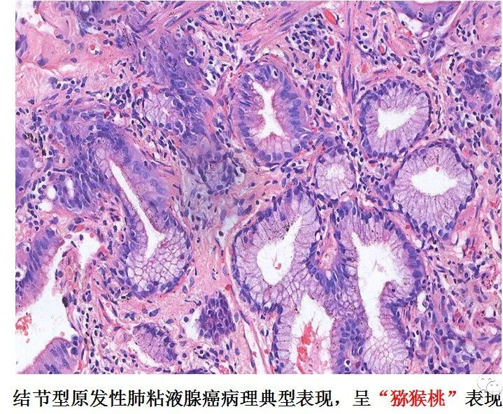 【病例】肺结节2例影像讨论 【病例】肺结节2例影像讨论