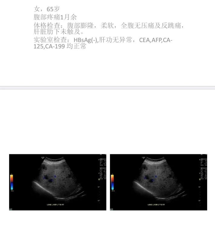 【病例】肝脏原发性血管肉瘤1例CT影像讨论 【病例】肝脏原发性血管肉瘤1例CT影像讨论