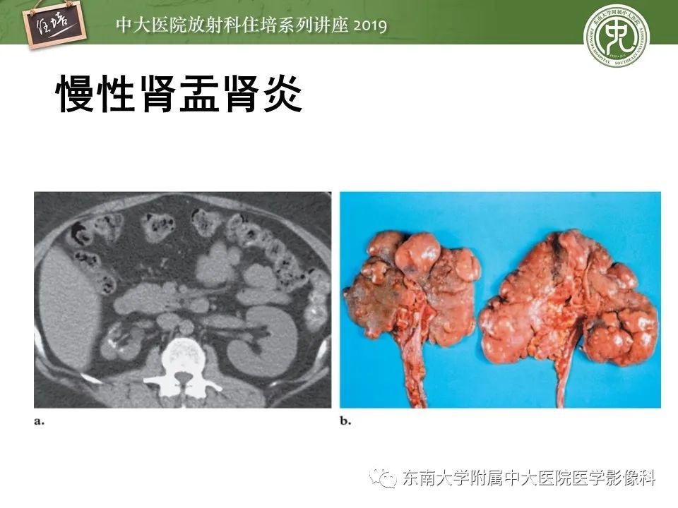 【PPT】肾脏感染性病变的影像学表现