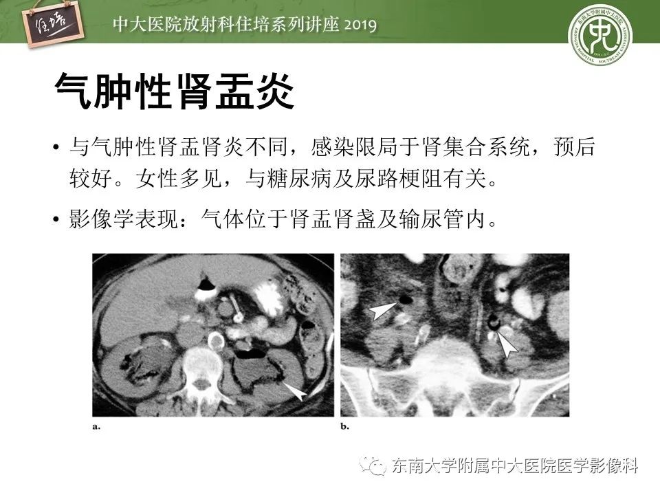 【PPT】肾脏感染性病变的影像学表现