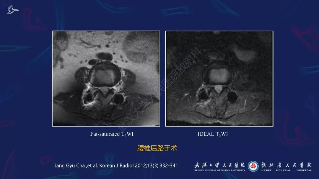 【PPT】肌骨MRI金属伪影抑制技术临床应用