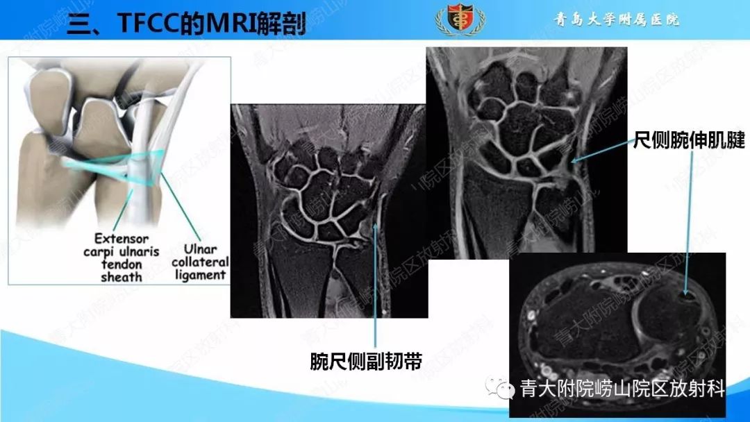 【PPT】TFCC损伤的MRI诊断