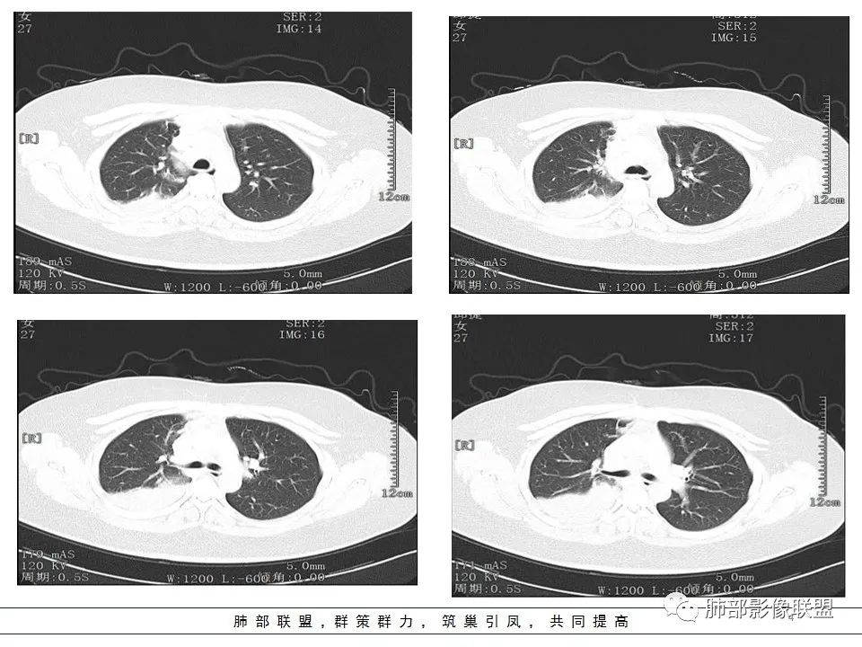 【病例】右中下肺典型类癌1例CT影像讨论 【病例】右中下肺典型类癌1例CT影像讨论