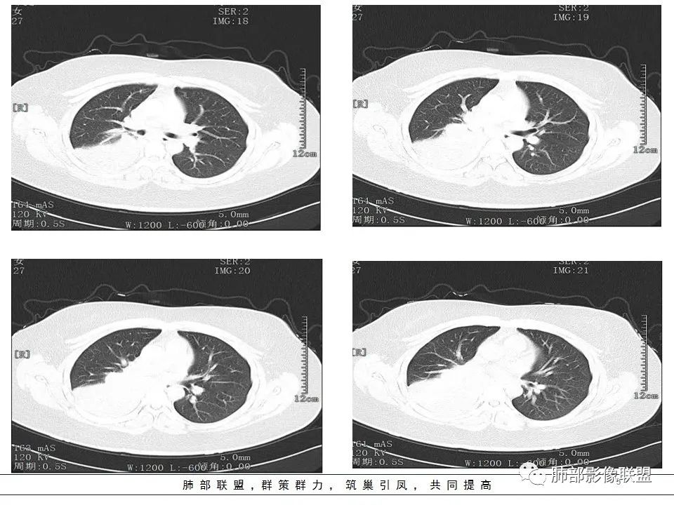 【病例】右中下肺典型类癌1例CT影像讨论 【病例】右中下肺典型类癌1例CT影像讨论