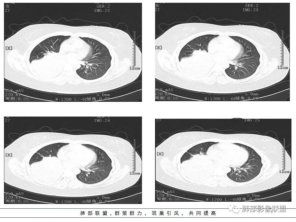 【病例】右中下肺典型类癌1例CT影像讨论 【病例】右中下肺典型类癌1例CT影像讨论