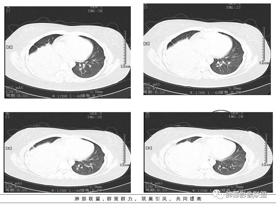 【病例】右中下肺典型类癌1例CT影像讨论 【病例】右中下肺典型类癌1例CT影像讨论