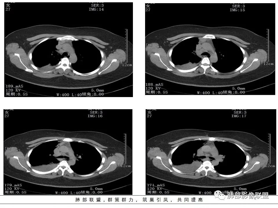 【病例】右中下肺典型类癌1例CT影像讨论 【病例】右中下肺典型类癌1例CT影像讨论