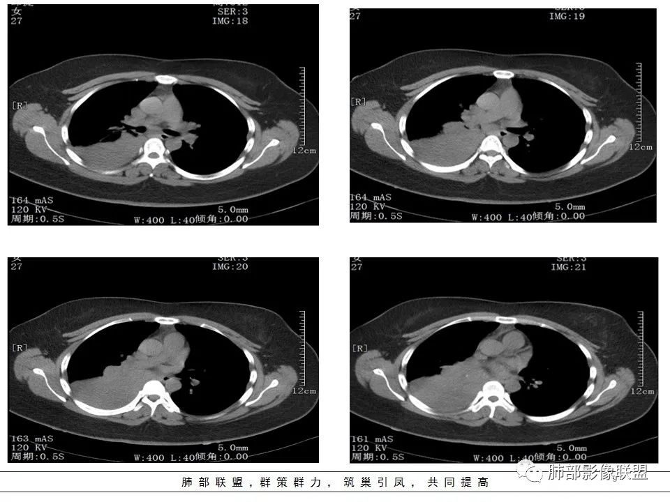 【病例】右中下肺典型类癌1例CT影像讨论 【病例】右中下肺典型类癌1例CT影像讨论