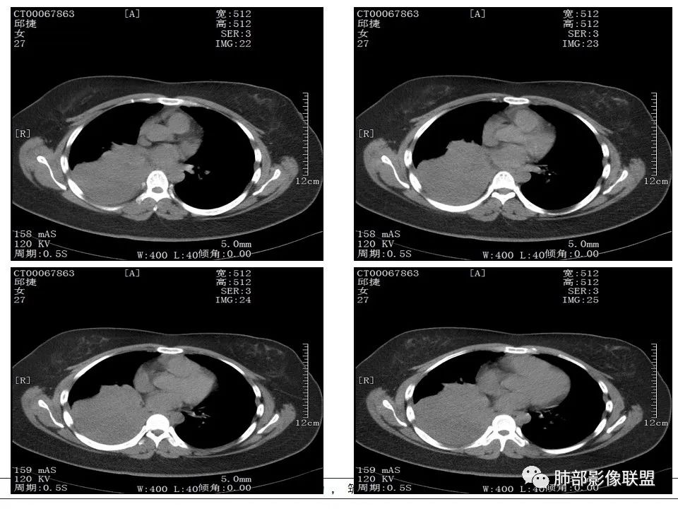 【病例】右中下肺典型类癌1例CT影像讨论 【病例】右中下肺典型类癌1例CT影像讨论