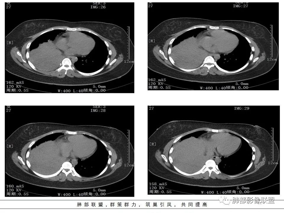 【病例】右中下肺典型类癌1例CT影像讨论 【病例】右中下肺典型类癌1例CT影像讨论