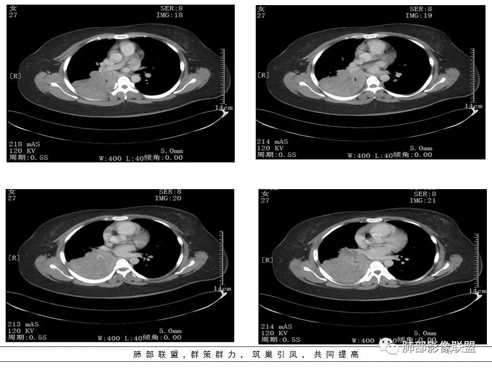 【病例】右中下肺典型类癌1例CT影像讨论 【病例】右中下肺典型类癌1例CT影像讨论
