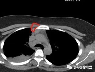 【病例】右中下肺典型类癌1例CT影像讨论 【病例】右中下肺典型类癌1例CT影像讨论