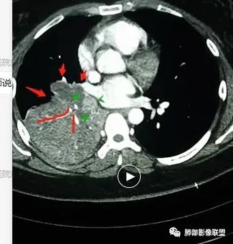【病例】右中下肺典型类癌1例CT影像讨论 【病例】右中下肺典型类癌1例CT影像讨论