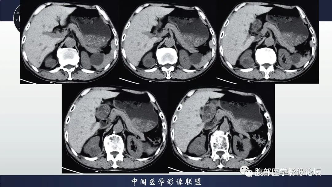 【病例】右肾嗜酸细胞腺瘤1例CT影像 【病例】右肾嗜酸细胞腺瘤1例CT影像