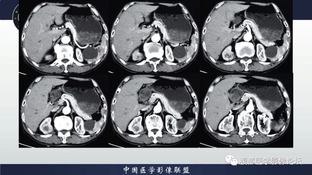 【病例】右肾嗜酸细胞腺瘤1例CT影像