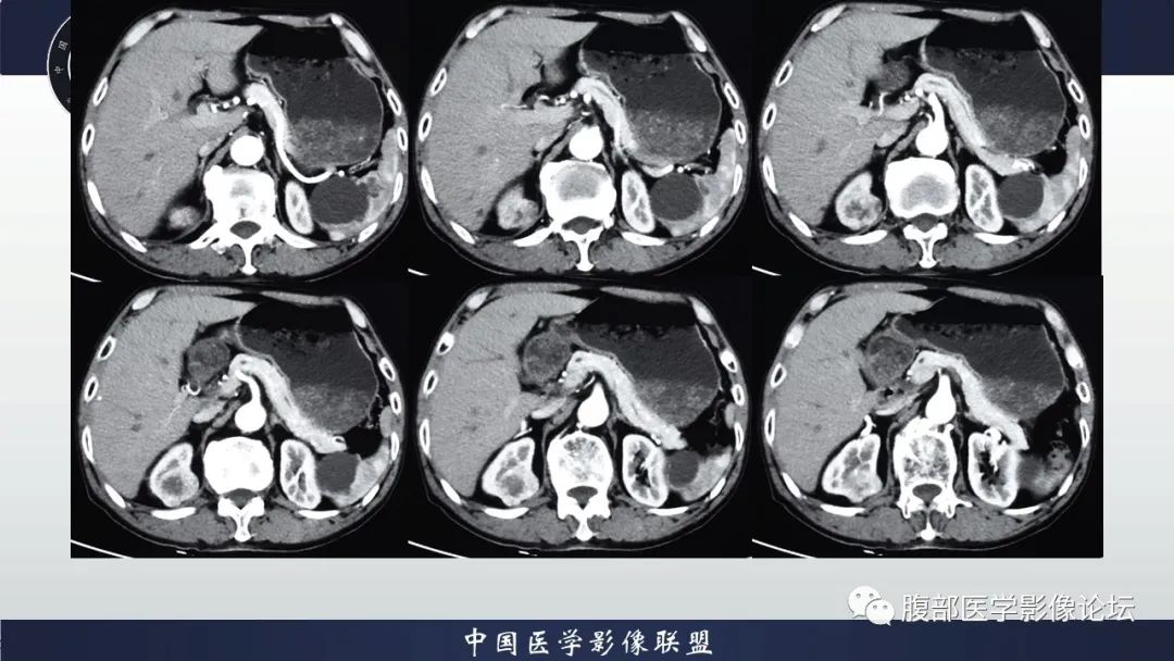 【病例】右肾嗜酸细胞腺瘤1例CT影像 【病例】右肾嗜酸细胞腺瘤1例CT影像