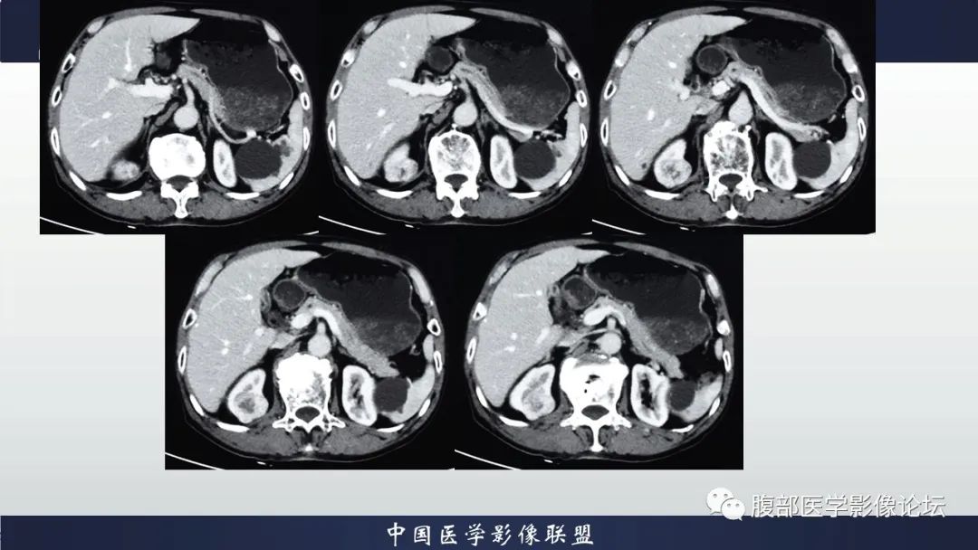 【病例】右肾嗜酸细胞腺瘤1例CT影像 【病例】右肾嗜酸细胞腺瘤1例CT影像