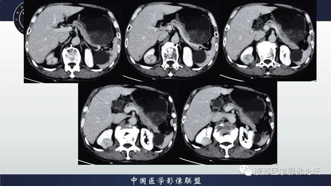【病例】右肾嗜酸细胞腺瘤1例CT影像 【病例】右肾嗜酸细胞腺瘤1例CT影像