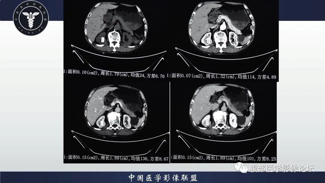 【病例】右肾嗜酸细胞腺瘤1例CT影像 【病例】右肾嗜酸细胞腺瘤1例CT影像