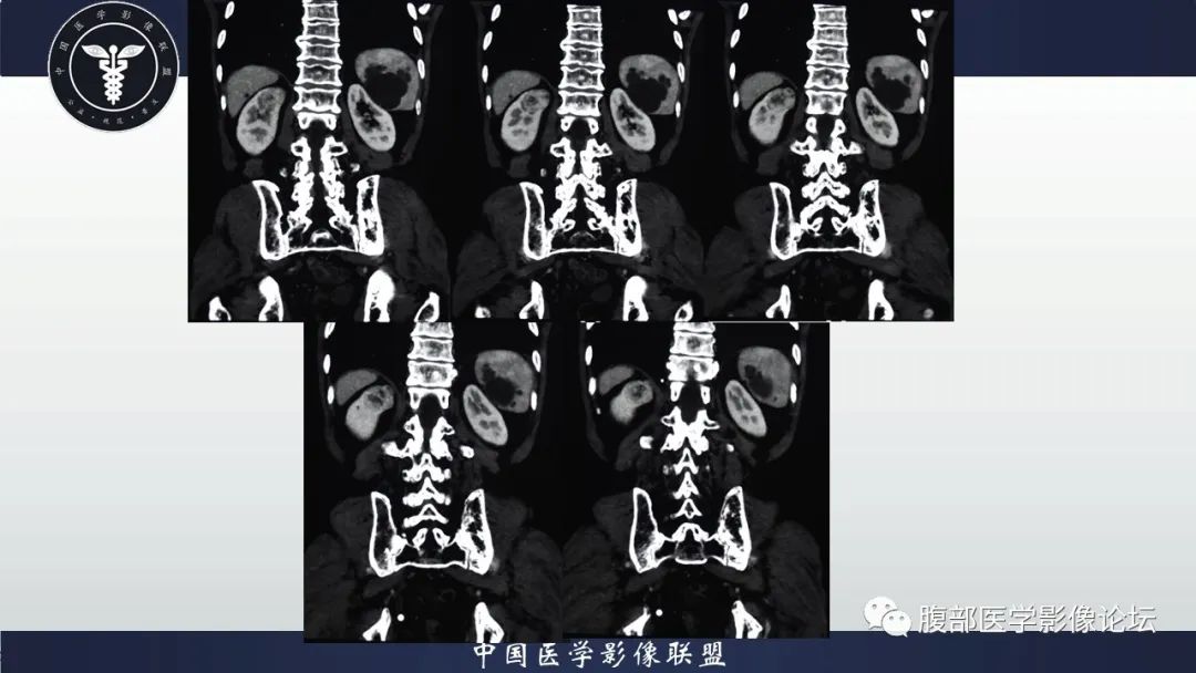 【病例】右肾嗜酸细胞腺瘤1例CT影像 【病例】右肾嗜酸细胞腺瘤1例CT影像