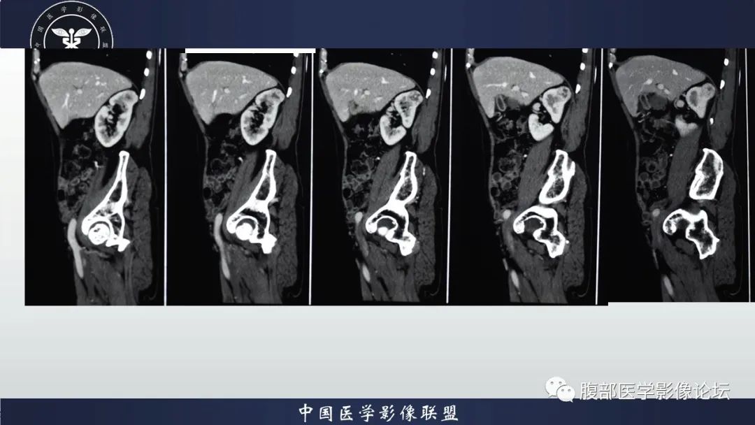 【病例】右肾嗜酸细胞腺瘤1例CT影像 【病例】右肾嗜酸细胞腺瘤1例CT影像