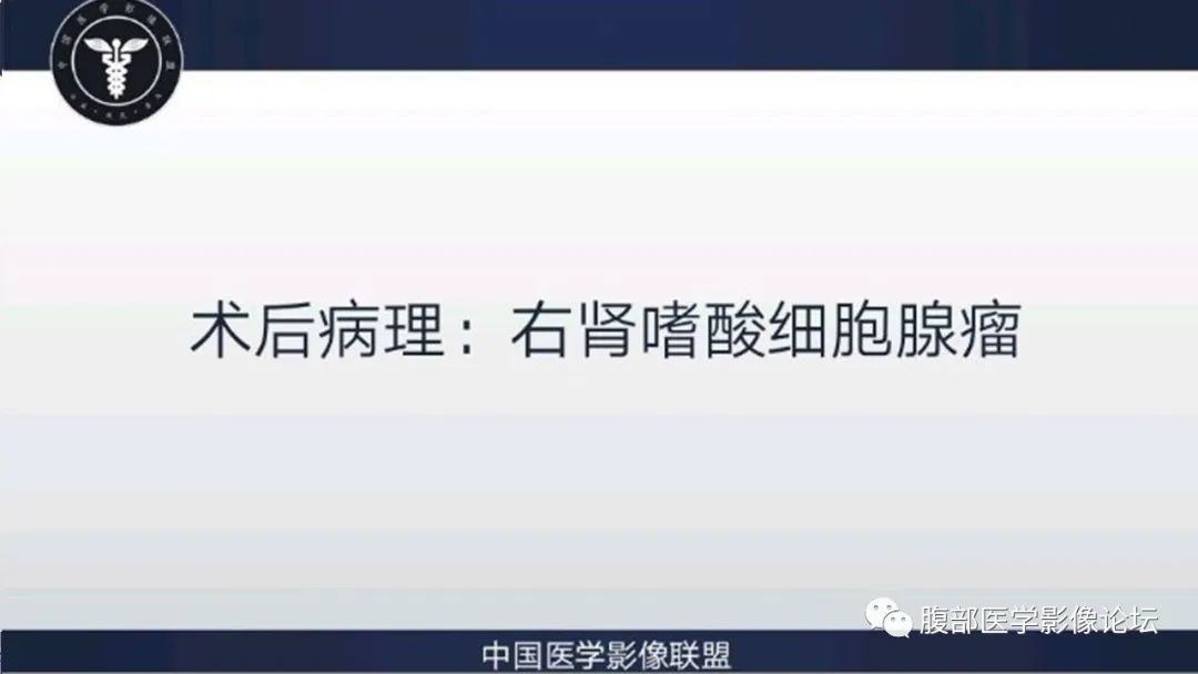【病例】右肾嗜酸细胞腺瘤1例CT影像 【病例】右肾嗜酸细胞腺瘤1例CT影像