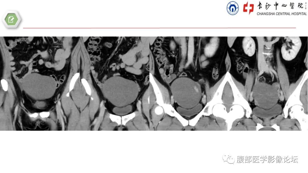 【病例】卵巢甲状腺肿1例CT影像 【病例】卵巢甲状腺肿1例CT影像
