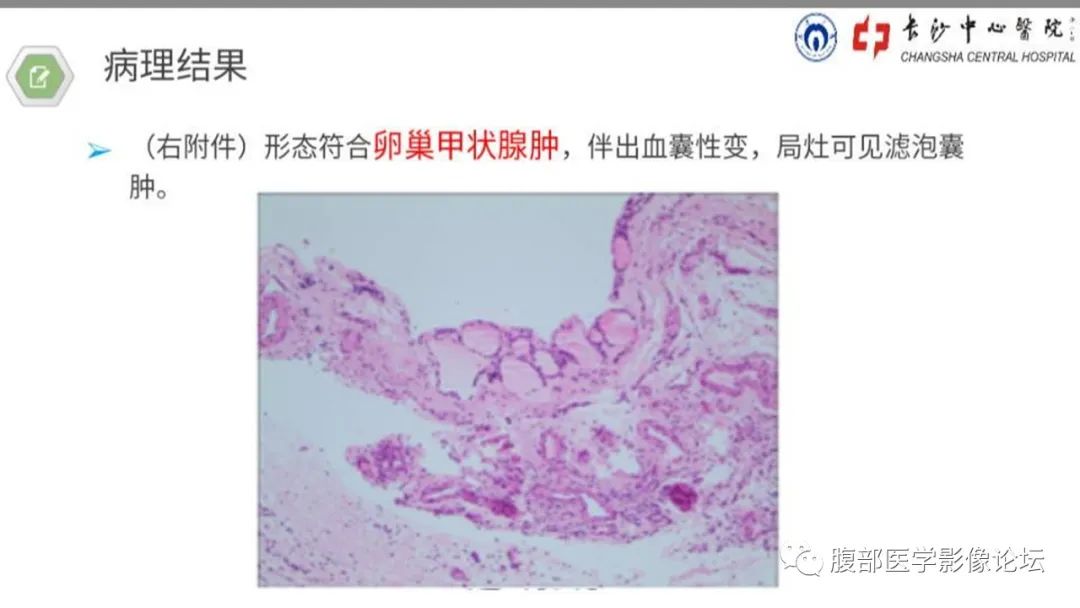 【病例】卵巢甲状腺肿1例CT影像 【病例】卵巢甲状腺肿1例CT影像