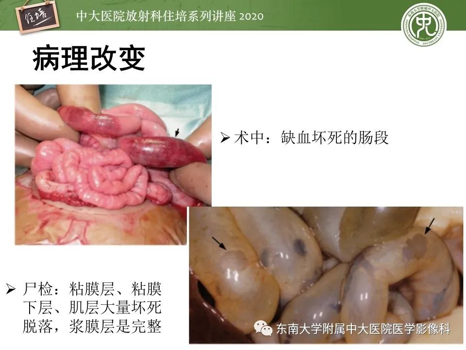 【PPT】新生儿坏死性小肠结肠炎的影像学表现