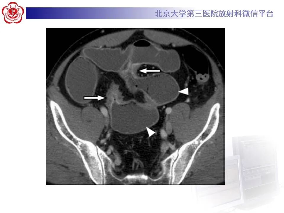 【PPT】炎症性肠病的CT/MRI诊断 第三部分:检查方法