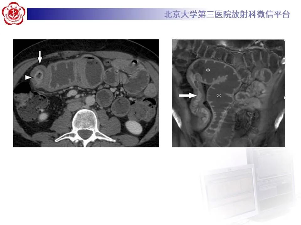 【PPT】炎症性肠病的CT/MRI诊断 第三部分:检查方法