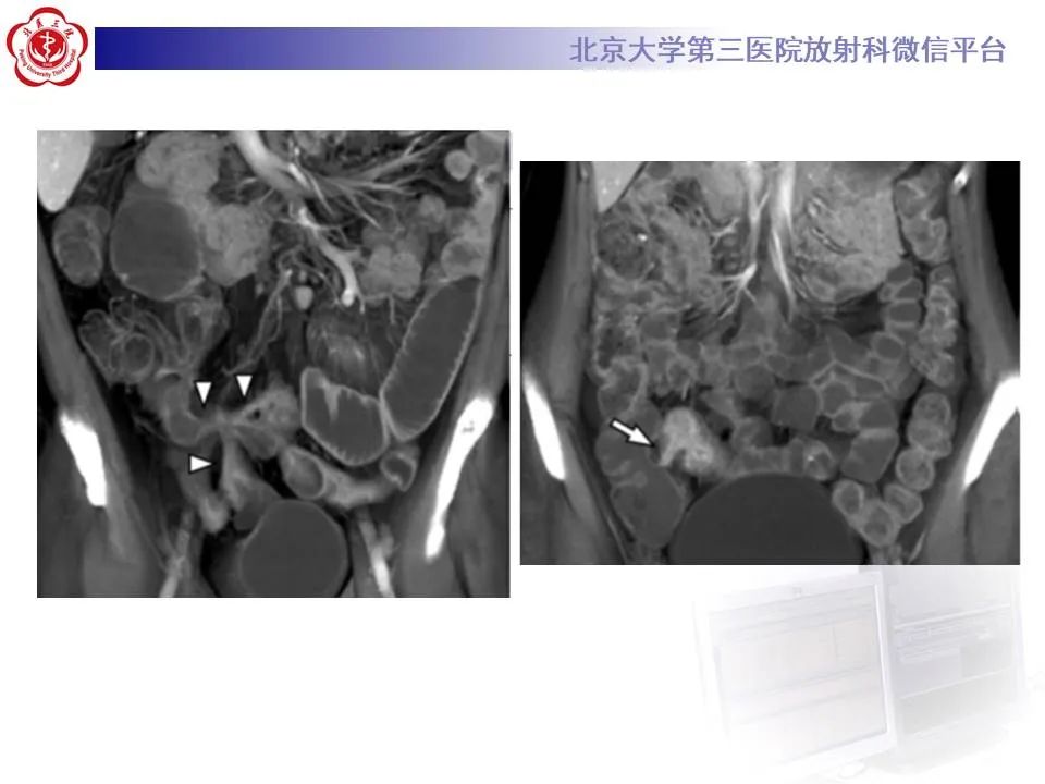 【PPT】炎症性肠病的CT/MRI诊断 第三部分:检查方法