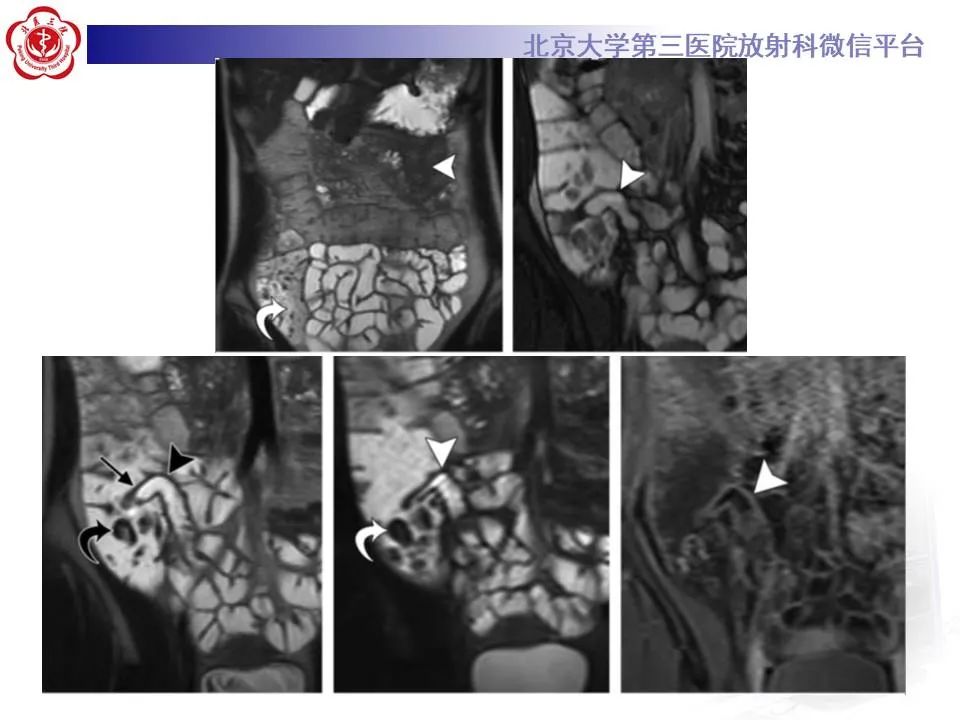 【PPT】炎症性肠病的CT/MRI诊断 第三部分:检查方法