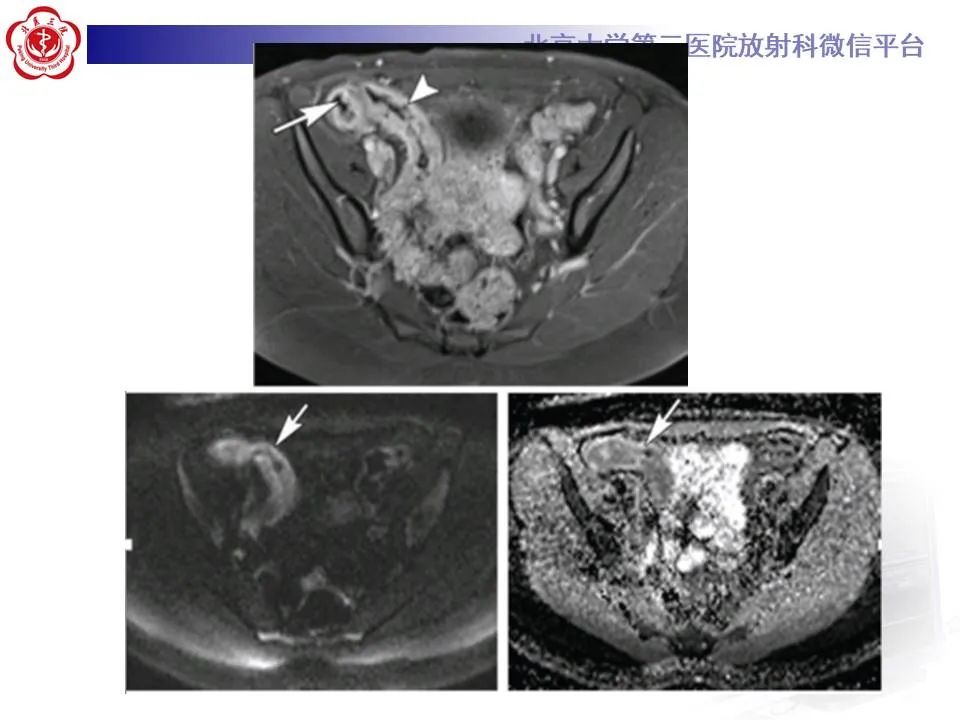 【PPT】炎症性肠病的CT/MRI诊断 第三部分:检查方法