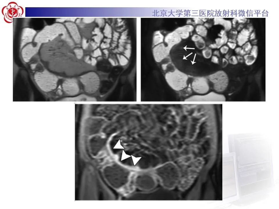 【PPT】炎症性肠病的CT/MRI诊断 第三部分:检查方法