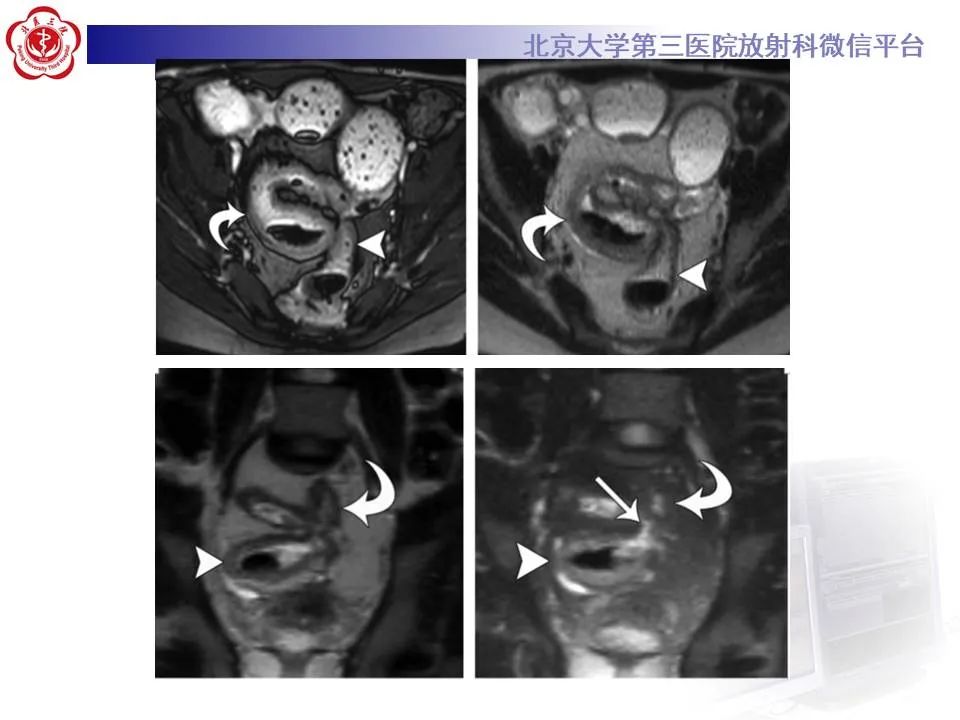 【PPT】炎症性肠病的CT/MRI诊断 第三部分:检查方法