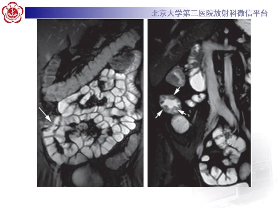 【PPT】炎症性肠病的CT/MRI诊断 第三部分:检查方法