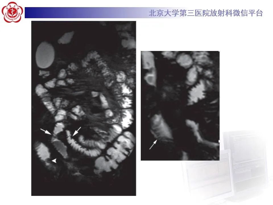 【PPT】炎症性肠病的CT/MRI诊断 第三部分:检查方法