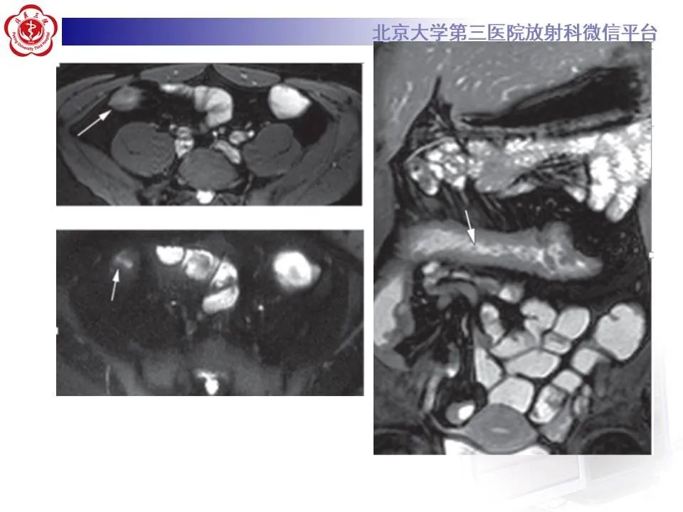 【PPT】炎症性肠病的CT/MRI诊断 第三部分:检查方法