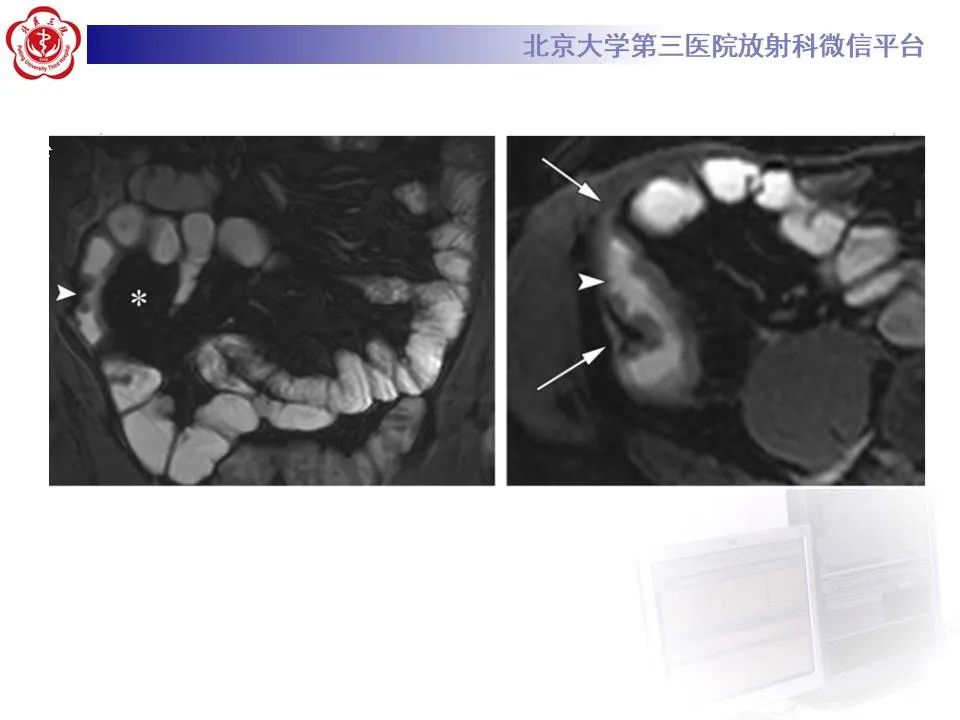 【PPT】炎症性肠病的CT/MRI诊断 第三部分:检查方法